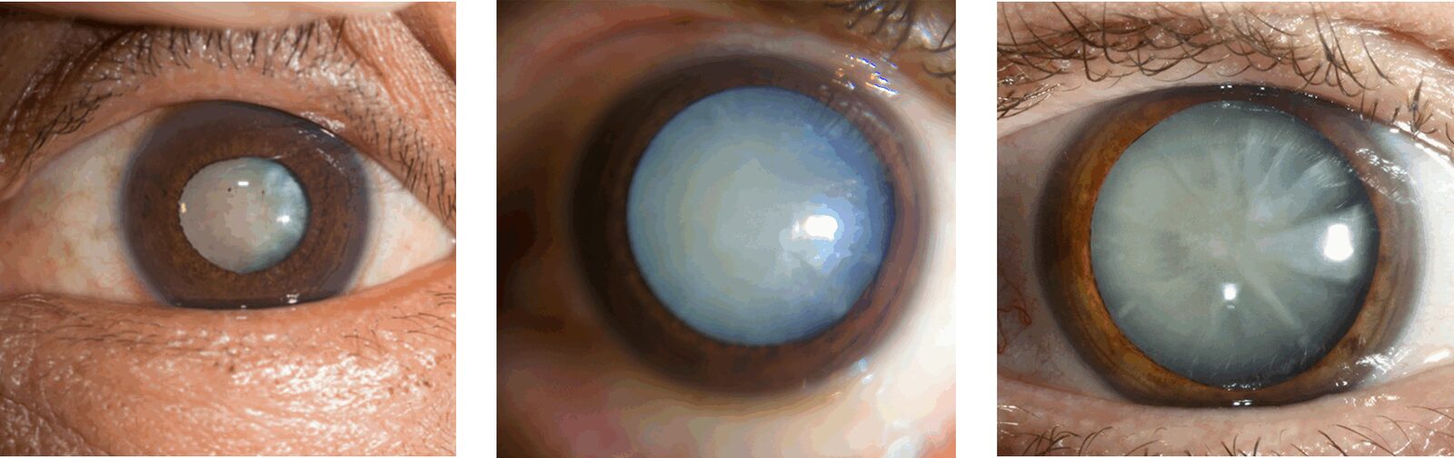 photo - cataract
